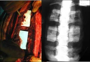 spine
